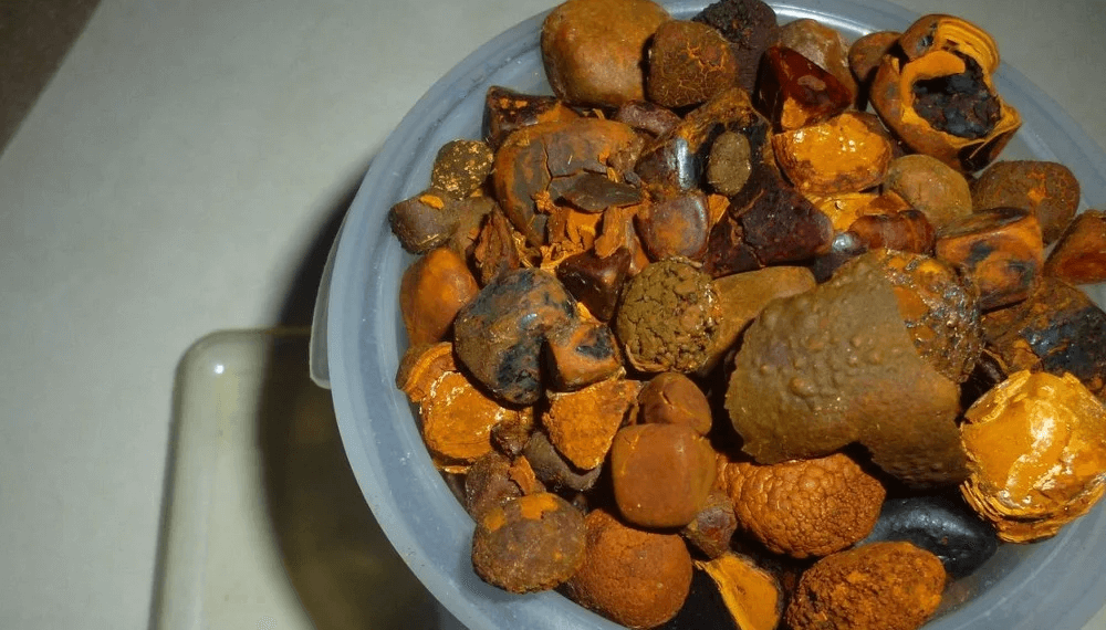 Se aprobó el protocolo de exportación de cálculos biliares