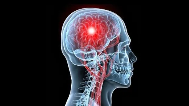 ACV: Prevenir salva vidas